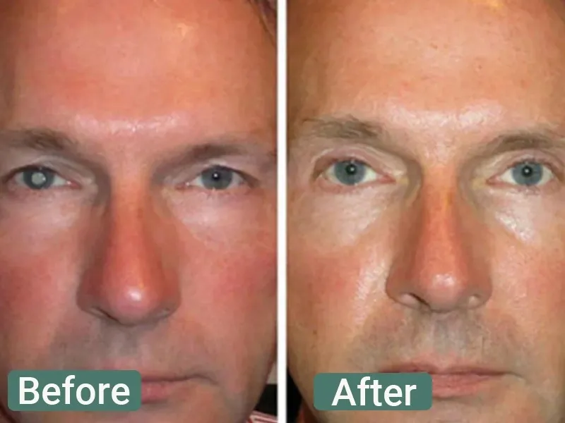 Before image for Michael T., 70